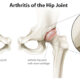 Best chair for hip osteoarthritis